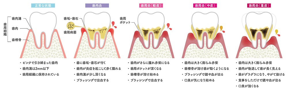【正確な状態】・ピンクで引き締まった歯肉 ・歯肉溝は2mm以下 ・歯周組織に保持されている 【歯肉炎】・歯に歯垢・歯石がつく ・歯肉が炎症をおこして赤く腫れる ・歯肉溝が少し深くなる ・ブラッシングで出血する 【歯周炎（軽度）】・歯肉がさらに腫れ赤紫になる ・歯周ポケットが深くなる ・歯槽骨が溶けはじめる ・ブラッシングで出血する 【歯周炎（中度）】・歯肉は大きく膨らみ赤紫 ・歯槽骨が溶け歯が動くようになる ・ブラッシングで膿や血が出る ・口臭が気になりはじめる 【歯周炎（重度）】・歯肉は大きく膨らみ赤紫 ・歯肉が後退して歯が長く見える ・歯がグラグラになり、やがて抜ける ・食事をしただけで膿や血が出る ・口臭が強くなる