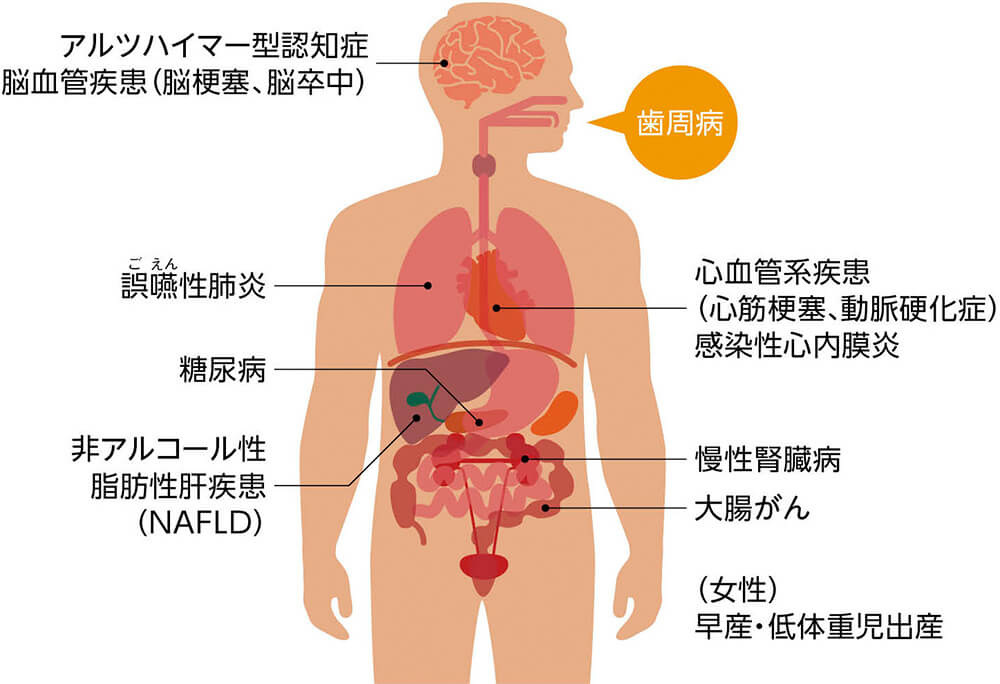 アルツハイマー型認知症 脳血管疾患（脳梗塞、脳卒中） 誤嚥性肺炎 心血管系疾患（心筋梗塞、動脈硬化症） 感染性心内膜炎 糖尿病 非アルコール性脂肪肝炎（NAFLD） 慢性腎臓病 大腸がん （女性）早産・低体重児出産