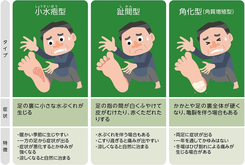 タイプ：小水疱型（しょうすいほうがた） 症状：足の裏に小さな水ぶくれが生じる。特徴：暖かい季節に生じやすい。一方の足から症状が出る。症状が悪化するとかゆみが強くなる。涼しくなると自然に治まる。　タイプ：趾間型（しかんがた） 症状：足の指の間が白くふやけて皮がむけたり、赤くただれたりする。特徴：水ぶくれを伴う場合もある。こすり過ぎると痛みが出やすい。涼しくなると自然に治まる。　タイプ：角化型（角質増殖型） 症状：かかとや足の裏全体が硬くなり、亀裂を伴う場合もある。特徴：両足に症状が出る。一年を通してかゆみはない。冬場は足のひび割れによる痛みが生じる場合がある。