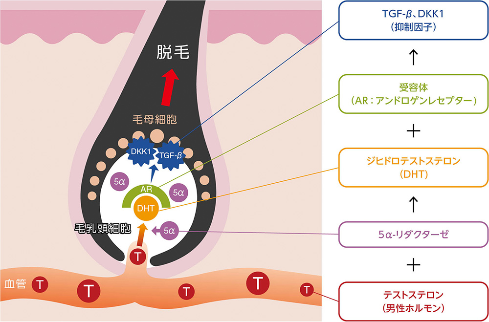 男性ホルモンによる脱毛メカニズムの説明図。詳細は下記。