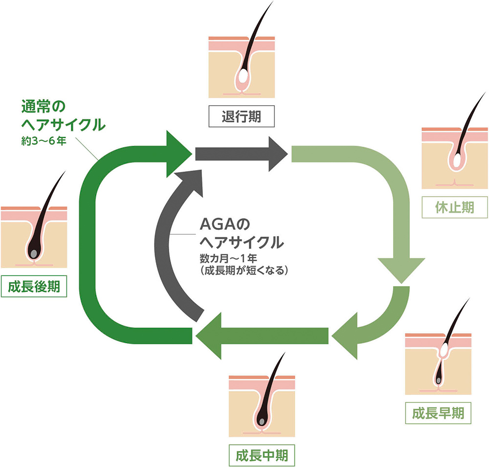 通常のヘアサイクルとAGAのヘアサイクルの説明図。