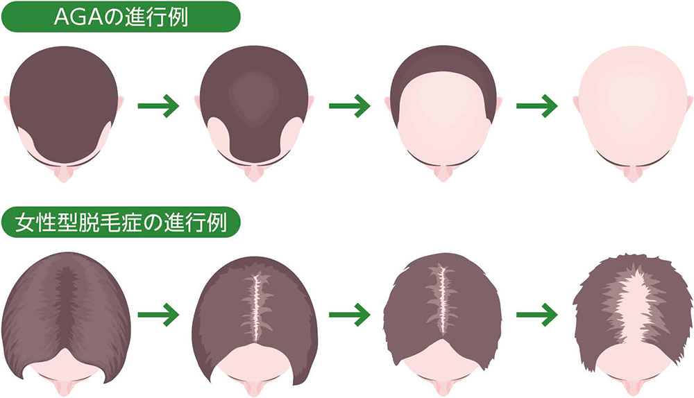 AGAと女性型脱毛症の進行具合の説明図。詳細は上記。