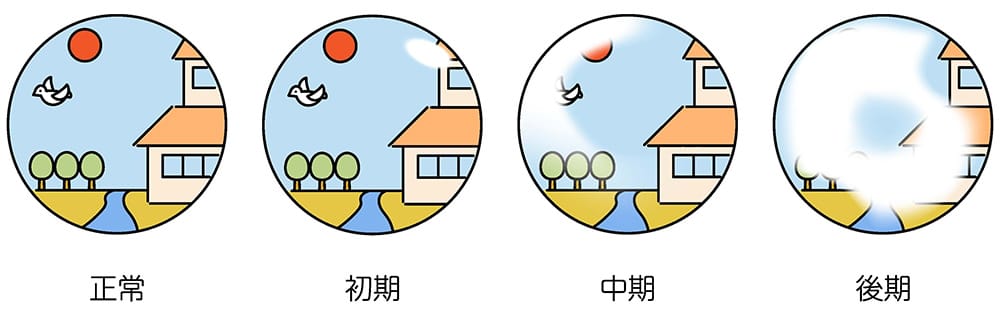 緑内障の見え方の変化をイメージしたイラスト。左から順に正常な視界、初期、中期、後期の視界を比較したもの。正常は鮮明な風景が見えており、初期は視界の一部にぼやけが現れ、中期はぼやけが拡大して視覚に障害が出始め、後期では視界の大部分が白く覆われ、ほとんど何も見えない状態を表している。