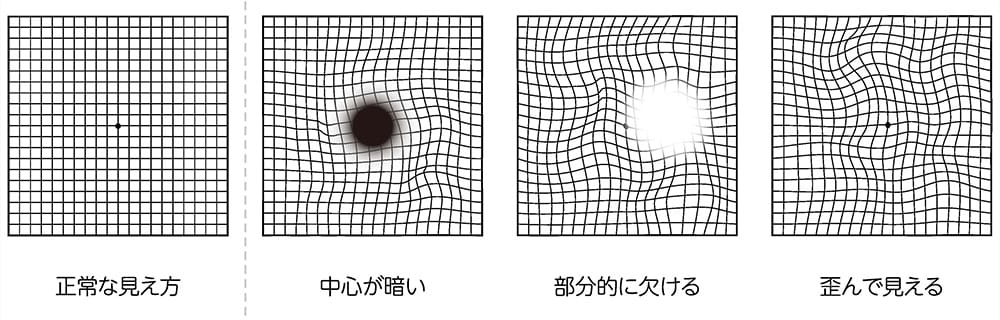 加齢黄斑変性の見え方をイメージしたイラスト。1つ目は正常な見え方を表し、均等な格子状の線がはっきりと見えている状態。2つ目は『中心が暗い』視野異常を示し、中央に黒い影が重なり格子が歪んでいる状態。3つ目は『部分的に欠ける』視野異常を示し、中央付近が白く欠けて格子が歪んでいる状態。4つ目は『歪んで見える』異常を示し、全体の格子が波打つように歪んだ状態が描かれている。